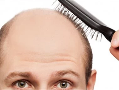 Πού οφείλεται και πώς αντιμετωπίζεται η έντονη τριχόπτωση;